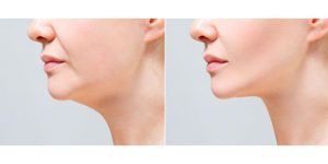 لیفت با نخ: مزایا، معایب و نکات مهم قبل و بعد از انجام آن